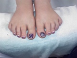 Purple lines on toes