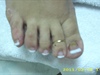 Toenail Reconstruction W/ pink and white