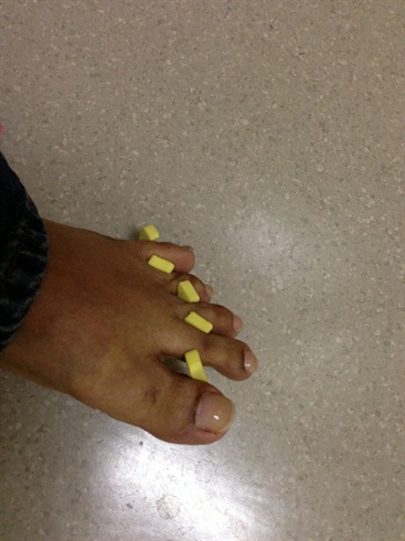 hump nails toes toenails toe-nails 