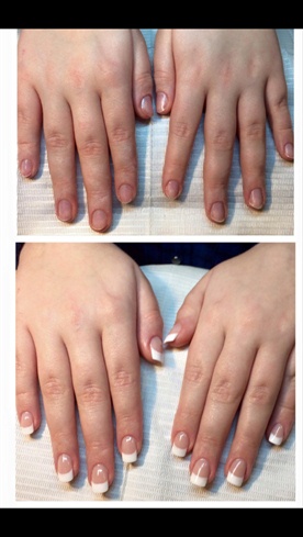 Before & After French Sculpted Acrylic - Nail Art Gallery