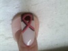 breast cancer nail